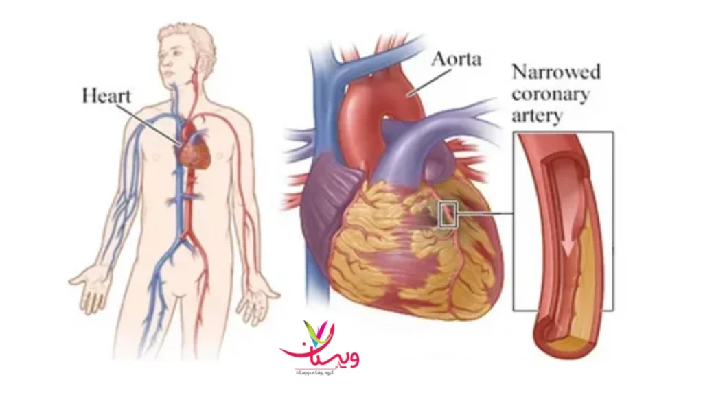 علائم سکته قلبی خفیف