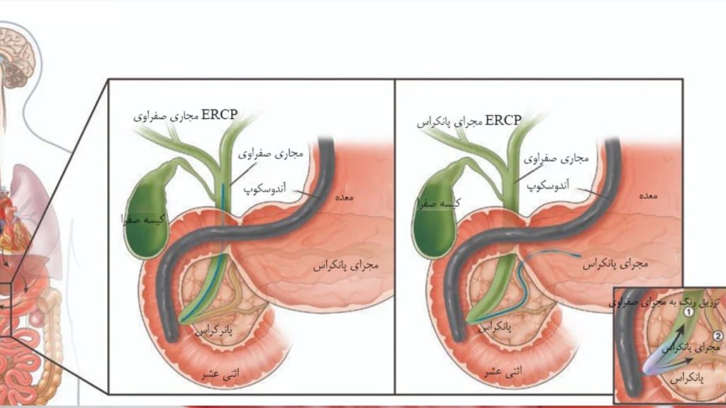 ERCP صفرا و پانکراس تصویر شماتیک با متن فارسی درباه نحوه انجام ای ار سی پی انواع ای ار سی پی صفراوی و پانکراس