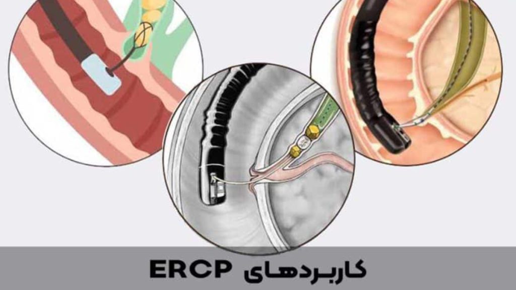 USES OF ERCP کاربردهای ای ار سی پی شامل چیست؟