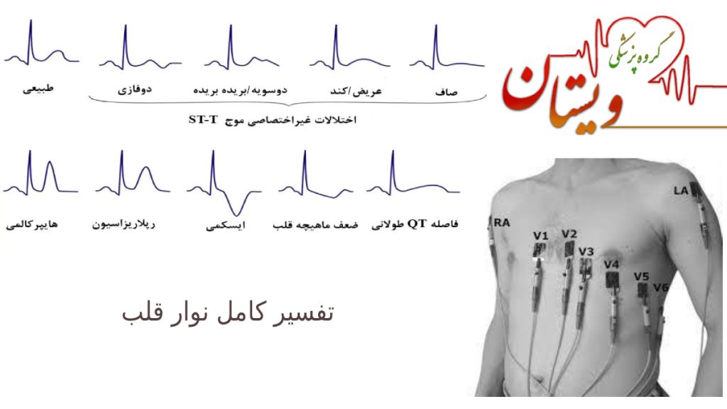 تفسیر نوار قلب یک تصویر جالب درباره انواع بیماری های قلبی که در نوار قلب نمایش داده می شود