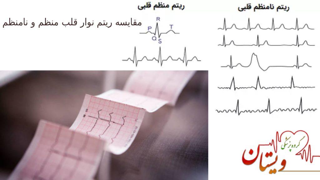 نوار قلب سالم و ناسالم مقایسه ریتم منظم قلبی و ریتم نامنظم قلبی در تست نوار قلب
