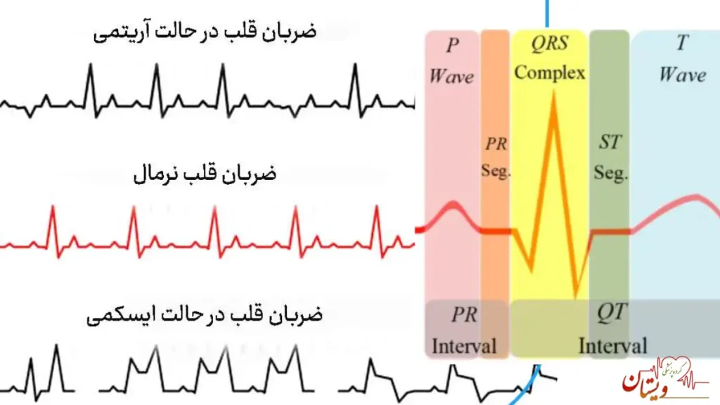 عکس نوار قلب سالم و ناسالم تصویری از نوار قلب در حالت های مختلف و بیماری های مختلف قلبی و حالت سالم