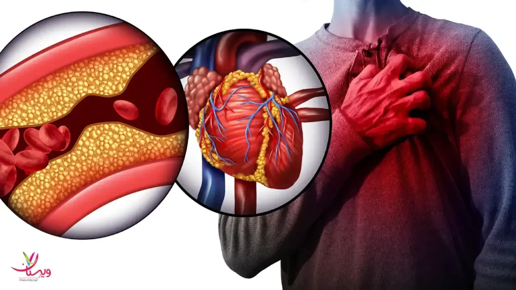 علت بروز آنژین قلب راهکار های ترک سیگار برای درمان آنژین قلبی