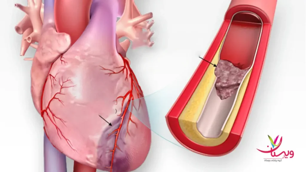 آنژیو پلاستی و استنت گذاری برای درمان آنژین قلب