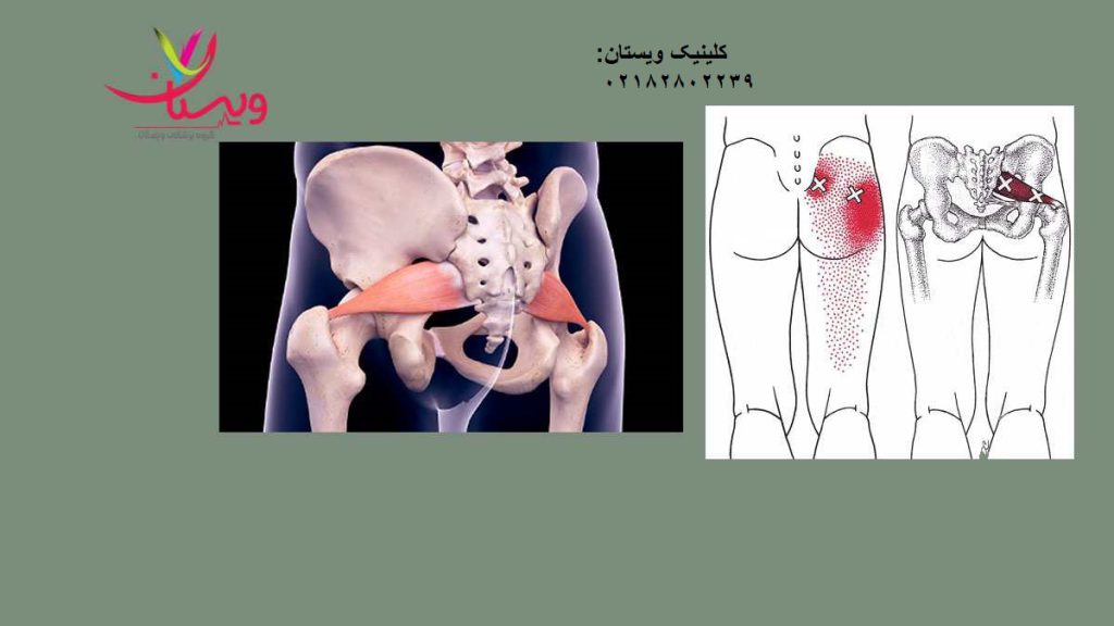 ستدروم پیریفورمیس