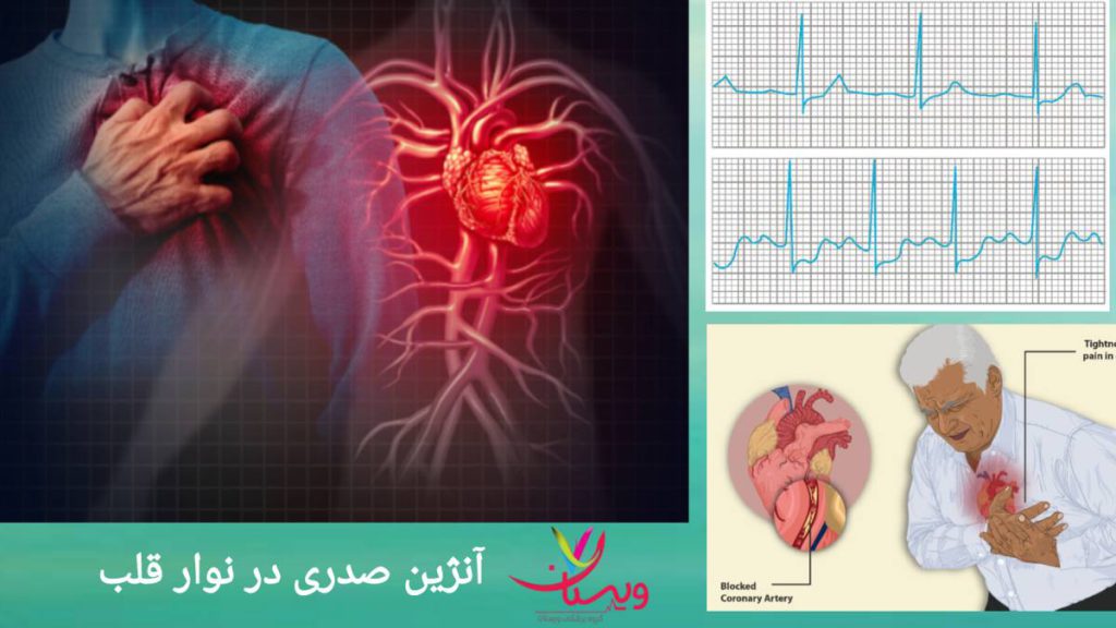 آنژین صدری در نوار قلب