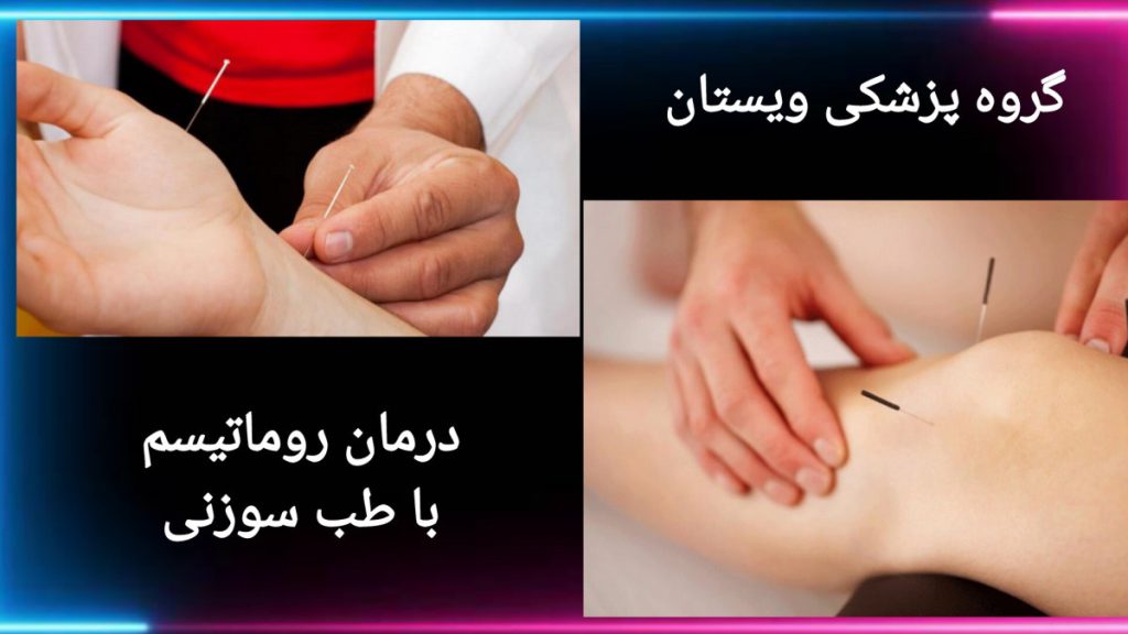استفاده از طب سوزنی برای درمان دردهای روماتیسمی درمان دردهای روماتیسمی با استفاده از طب سوزنی