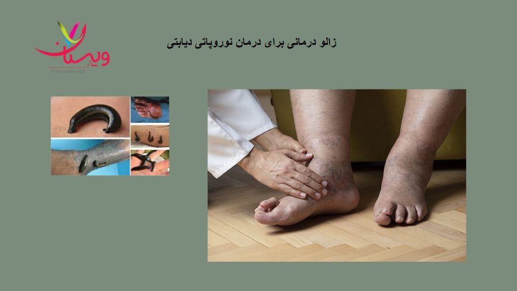 زالو درمانی نوروپاتی دیابتی