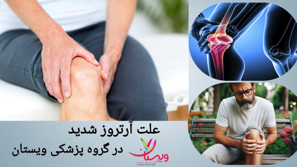 آرتروز شدید به دلیل فرسایش غضروف ها درد زانوی بیمار به دلیل آرتروز شدید