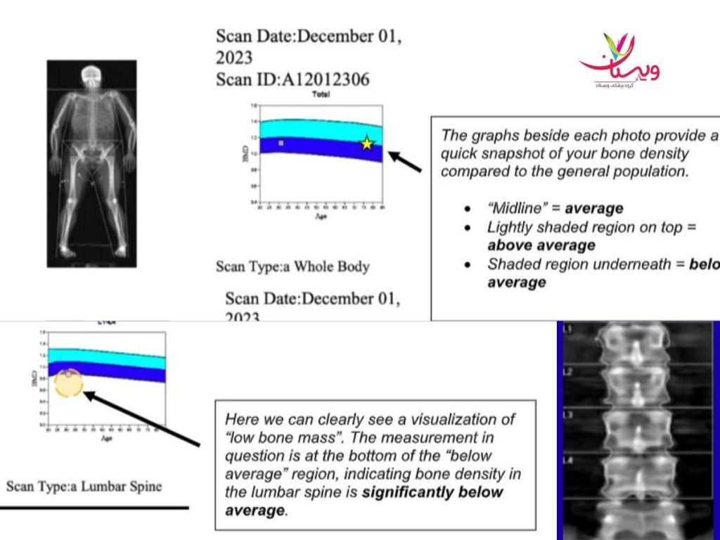 عوارض سنجش تراکم استخوان نی نی سایت