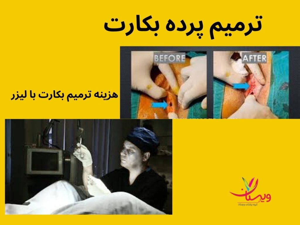 کیا پردشونو دوختن و هزینش؟ تجربه کسانی که ترميم بكارت با ليزرداشتند؟