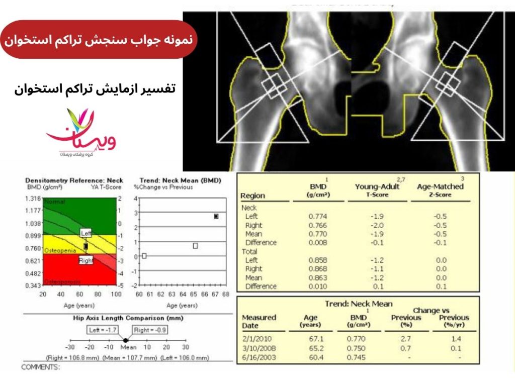 جواب آزمایش تراکم استخوان تفسیر خواندن جواب برگه آزمایش تراکم استخوان