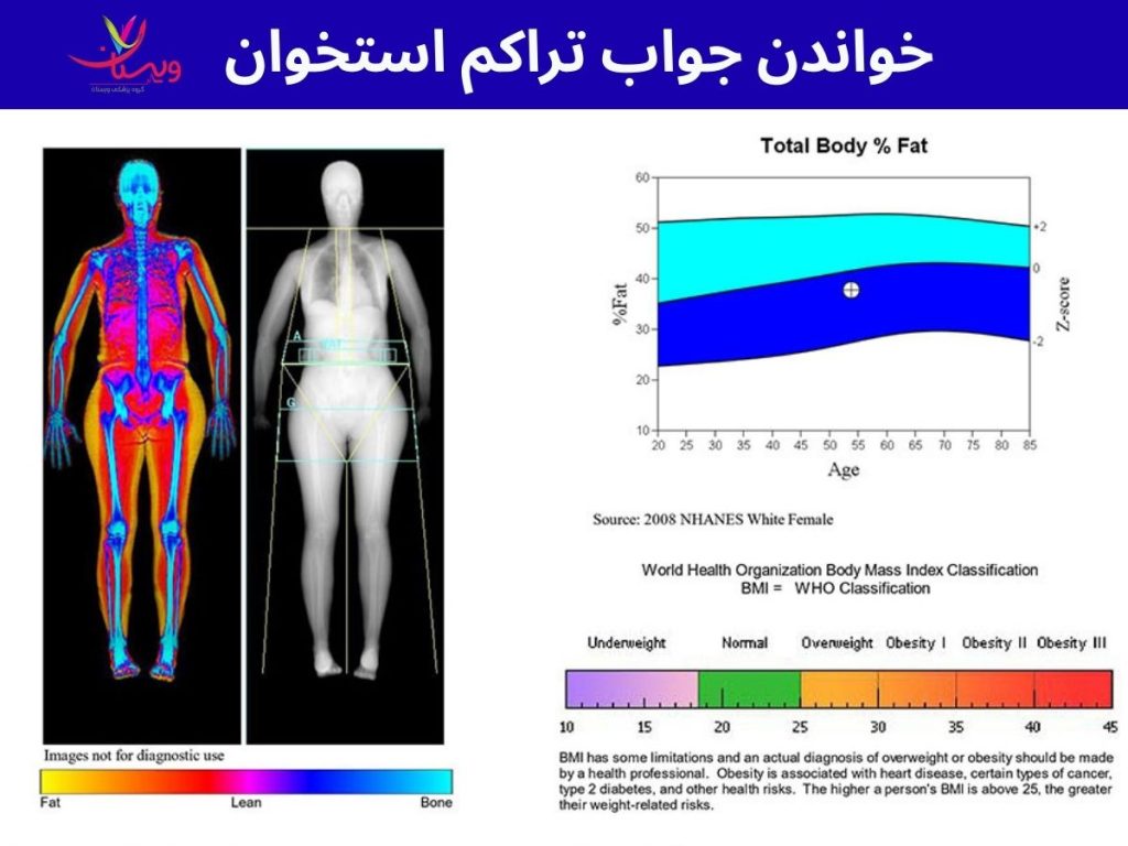 جدول تراکم استخوان تفسیر آزمایش پوکی استخوان