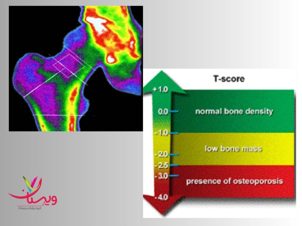 تفسیر تست تراکم استخوان تفسیر عکس تراکم استخوان