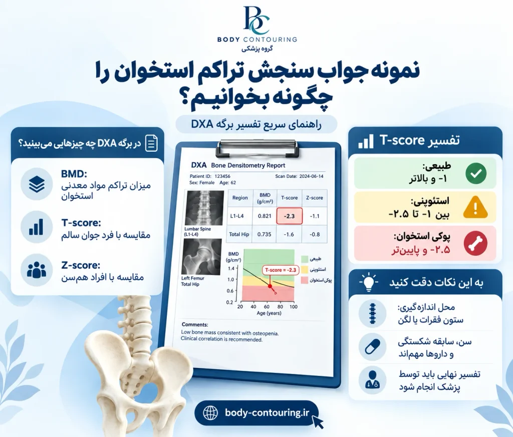 نتیجه نهایی بیمار فقط از روی جدول بالا تعیین نمیشود؛ پزشک باید کیفیت اسکن، سابقه شکستگی، عوامل خطر و شرایط پزشکی فرد را نیز بررسی کند. نمونه جواب سنجش تراکم استخوان را چگونه بخوانیم؟