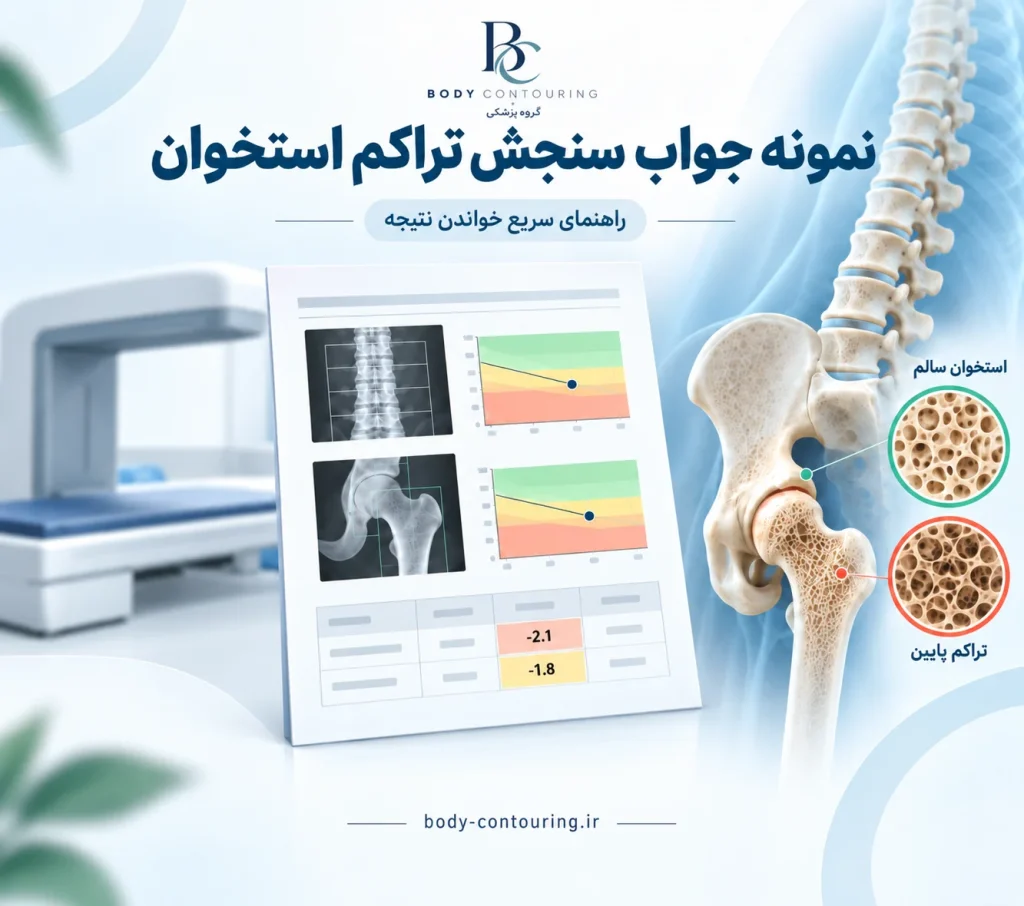 نمونه جواب سنجش تراکم استخوان؛ جدول T-score، Z-score و BMD