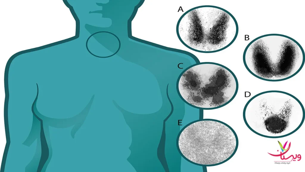 شکل های مختلف تیروئید آمادگی قبل از اسکن هستهای تیروئید