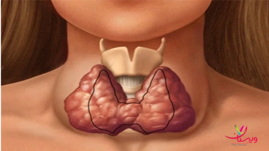 تیروئید زنان اتفاقات روز اسکن هسته ای تیروئید