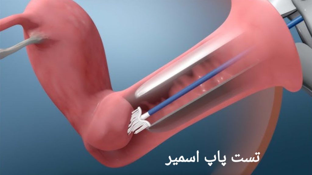 معرفی بهترین تست برای تشخیص سرطان دهانه رحم کاربرد آزمایش پاپ اسمیر در تشخیص سلول های سرطانی دهانه رحم