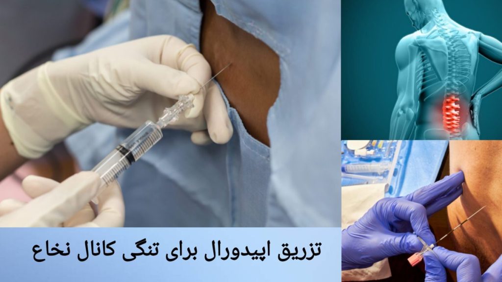تزریق دارو برای درمان تنگی کانال نخاع