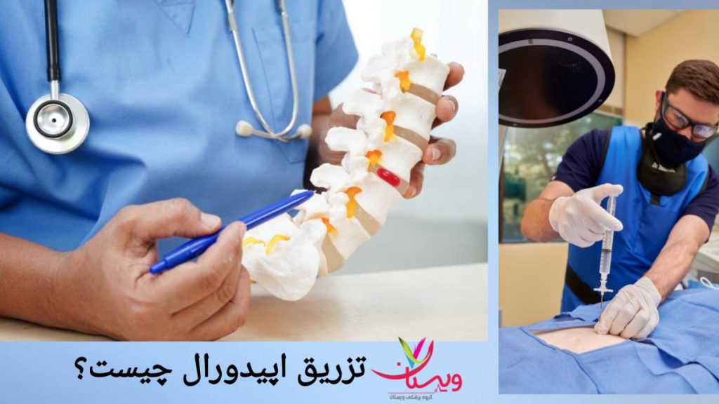 توضیح تزریق اپیدورال گردن و کمر توسط پزشک