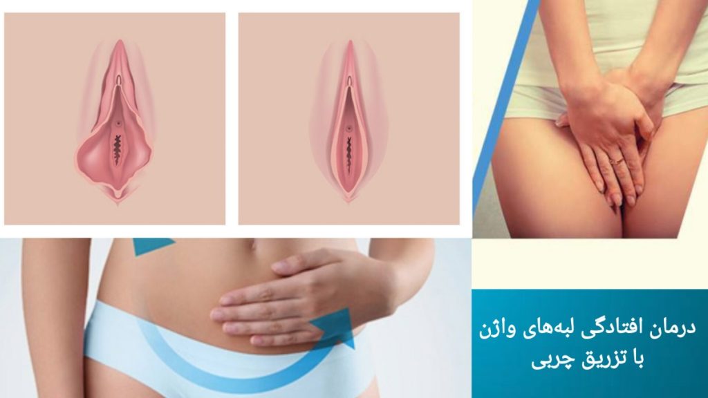 رفع افتادگی لبه های واژن با تزریق چربی رفع شل شدگی لبه های واژن با تزریق چربی