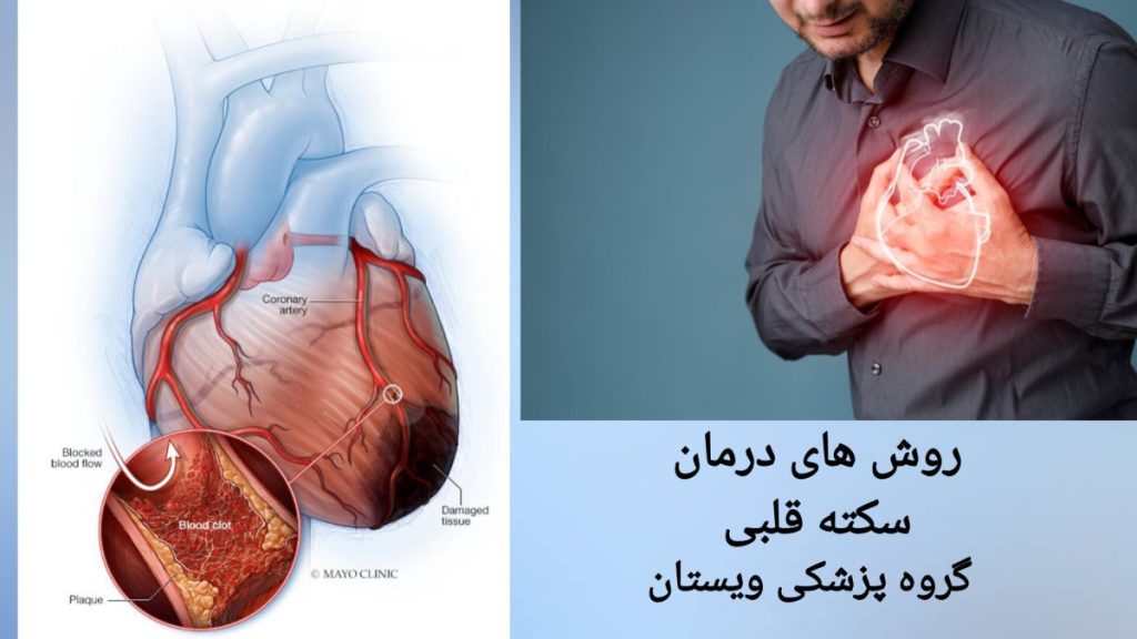 روش های درمان سکته قلبی