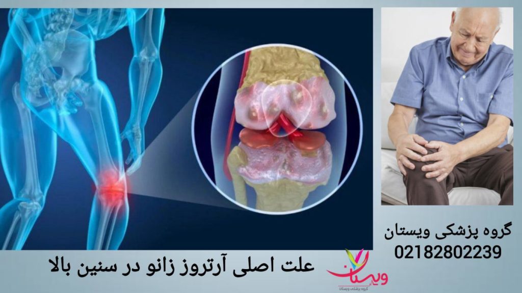 علت اصلی آرتروز زانو در سالمندان سالمندی با زانوی دردناک و عوامل موثر در آرتروز