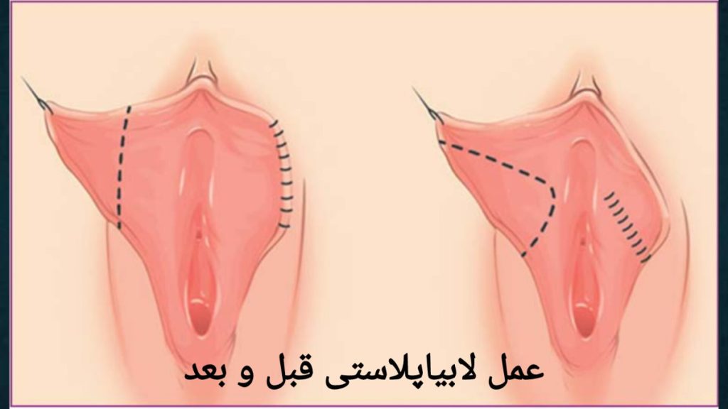تغییرات ظاهری پس از جراحی لابیاپلاستی مقایسه ظاهر واژن در لابیاپلاستی قبل و بعد