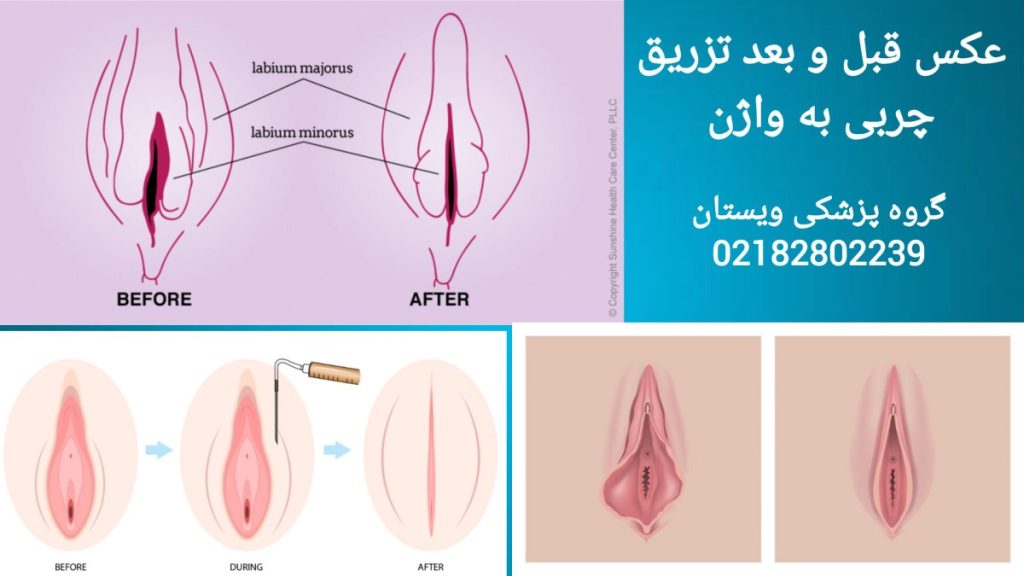 نتایج جوانسازی واژن با تزریق چربی قبل و بعد از تزریق چربی به واژن