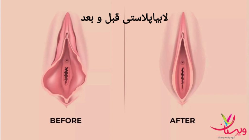 نتیجه لابیاپلاستی قبل و بعد