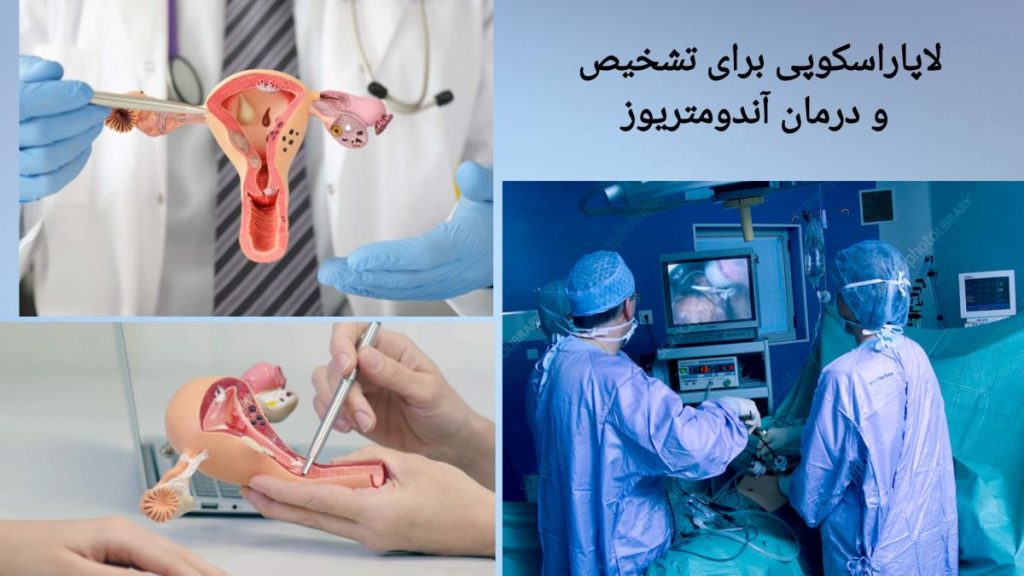 نقش لاپاراسکوپی در تشخیص آندومتریوز نمایی از درمان آندومتریوز با لاپاراسکوپی