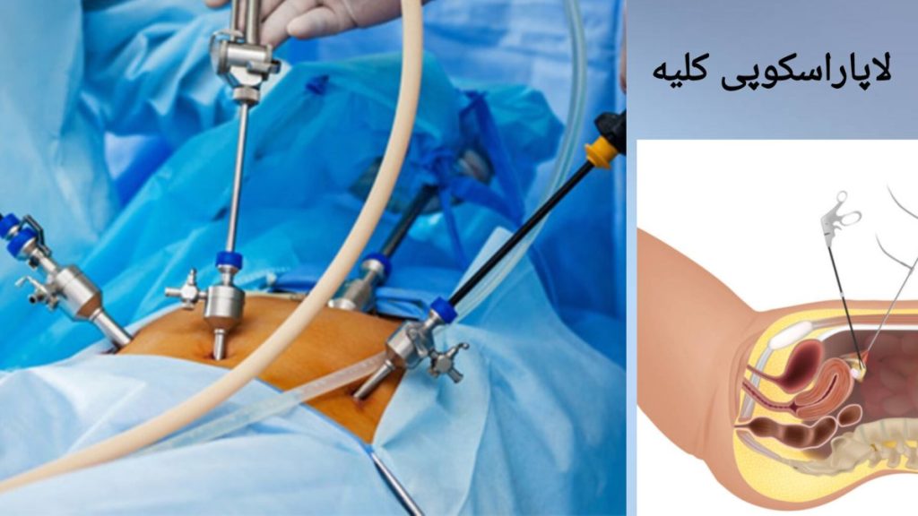 استفاده از لاپاراسکوپی برای درمان مشکلات کلیوی نمایی از انجام عمل لاپاراسکوپی کلیه در اتاق عمل