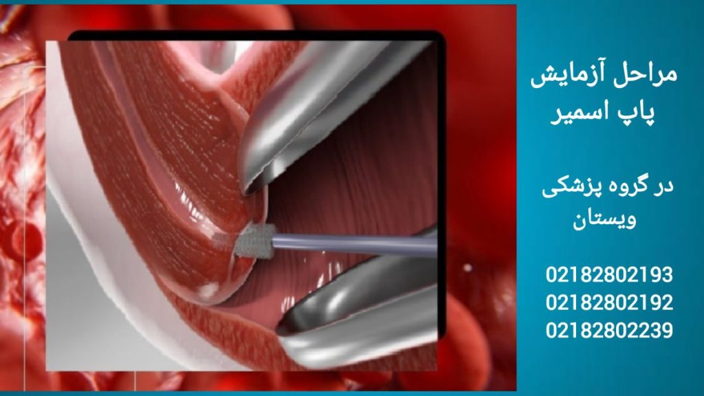 مراحل تست غربالگری دهانه رحم مراحل ساده برای انجام تست غربالگری دهانه رحم