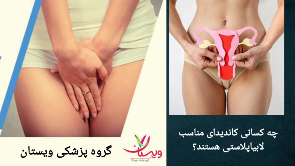 شرایط لازم برای انجام جراحی لابیا کاندیدای مناسب عمل لابیاپلاستی