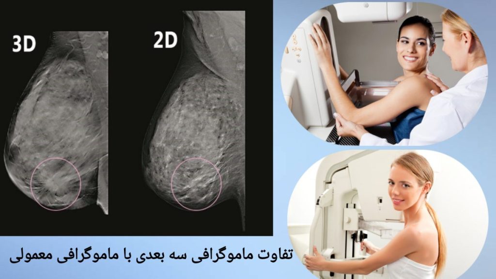 مقایسه ماموگرافی دیجیتال با سنتی تفاوت ماموگرافی دیجیتال با روش سنتی