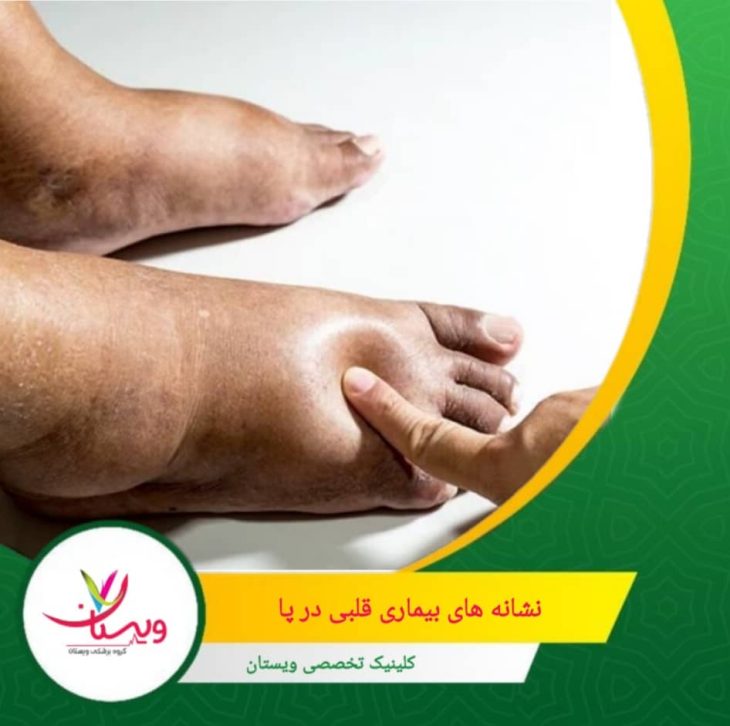 نشانه های بیماری قلبی در پا