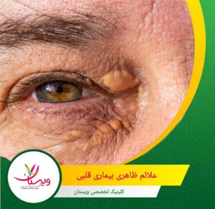 زمانی که قلب نتواند خون را بهدرستی پمپاژ کند، مایعات در اندامها جمع میشوند و باعث ورم میشوند. این حالت که به آن «ادم» گفته میشود. علائم ظاهری بیماری قلبی