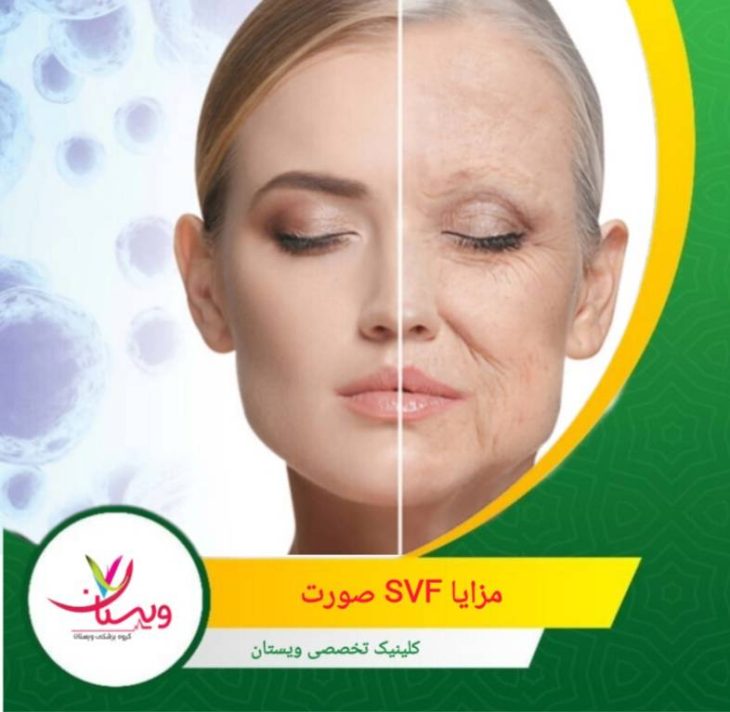 SVF صورت میتواند به طور همزمان: چروکها را کاهش دهد افتادگی خفیف تا متوسط را بهبود دهد. مزایایSVF صورت