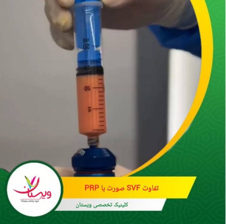 SVF صورت تعداد بسیار بیشتری سلول بنیادی دارد. تفاوت SVF صورت با PRP؛ کدام بهتر است؟