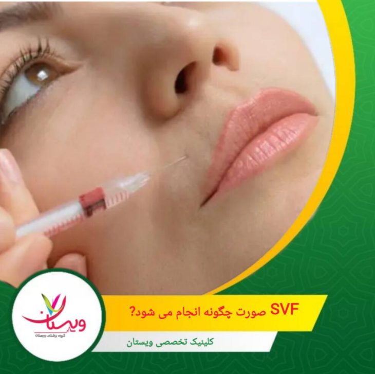 مقدار کمی چربی (معمولاً از شکم یا پهلو) با روش لیپوساکشن سبک و کمتهاجمی گرفته میشود. SVF صورت چگونه انجام میشود؟