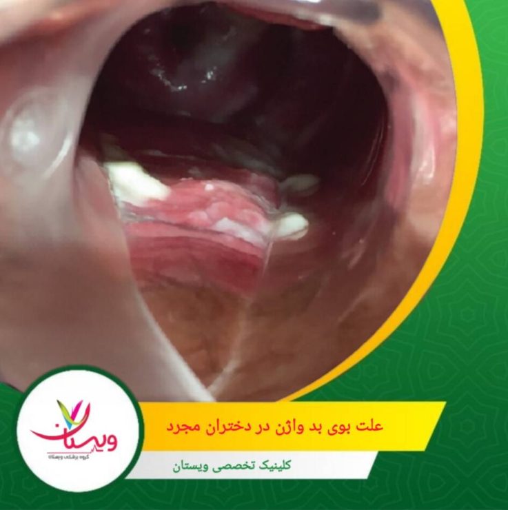 بوی بد واژن همیشه نشانه عفونت نیست، اما معمولاً یکی از هشدارهای اصلی است. علت بوی بد واژن دختران مجرد