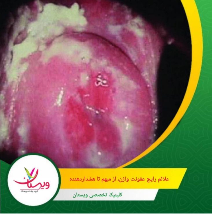 ترشحات غیرطبیعی: سفید و پنیری (اغلب در عفونتهای قارچی) از علائم عفونت واژن هستند. علائم رایج عفونت واژن، از مبهم تا هشداردهنده