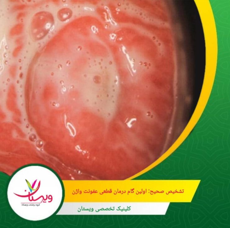 تشخیص صحیح بخش مهمی از فرایند درمان است، چرا که هر نوع عفونت درمان مخصوص به خود دارد. تشخیص صحیح: اولین گام درمان قطعی عفونت واژن