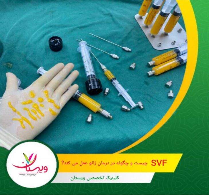 سلولهای اندوتلیال و فاکتورهای رشد باعث رشد رگهای جدید و بهبود تغذیه غضروف میشوند. SVF چیست و چگونه در درمان زانو عمل میکند؟