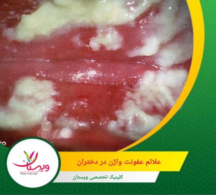 ممکن است ناحیه خارجی واژن (ولو) قرمز، متورم یا حساس شود. در کودکان، والدین اغلب هنگام تعویض لباس یا استحمام متوجه این تغییر میشوند. علائم عفونت واژن در دختران