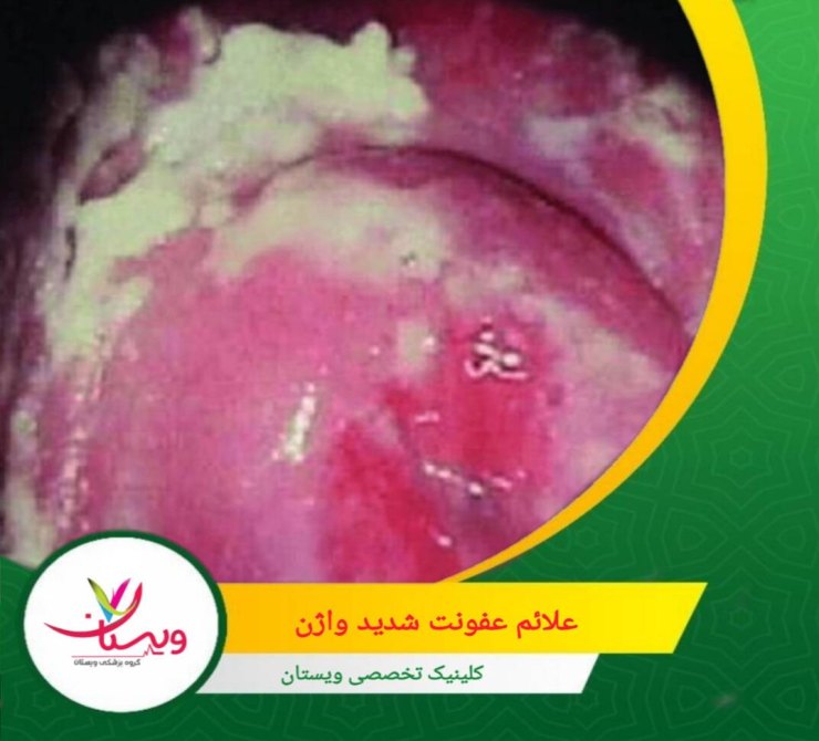 علائم عفونت شدید واژن