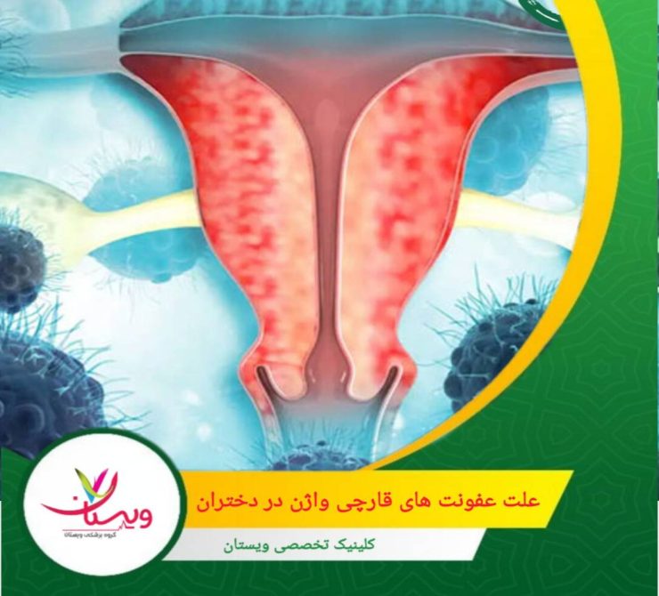 قارچ کاندیدا همیشه در بدن وجود دارد اما وقتی بیش از حد رشد کند، عفونت ایجاد میشود. علت عفونتهای قارچی واژن در دختران