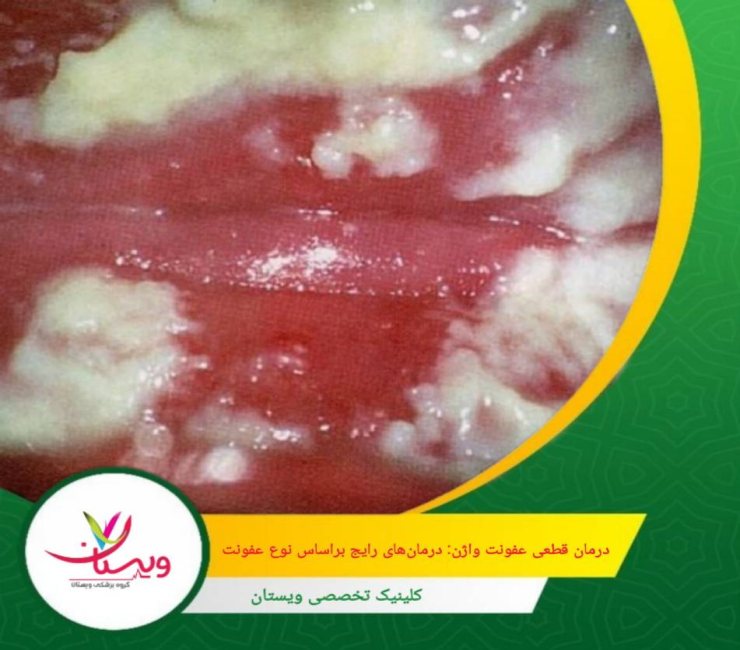 اگر عامل تشدیدکننده (مثل محصولات تحریککننده یا زمینههای خاص) باقی بماند، احتمال عود بالاتر میرود. درمان قطعی عفونت واژن: درمانهای رایج بر اساس نوع عفونت
