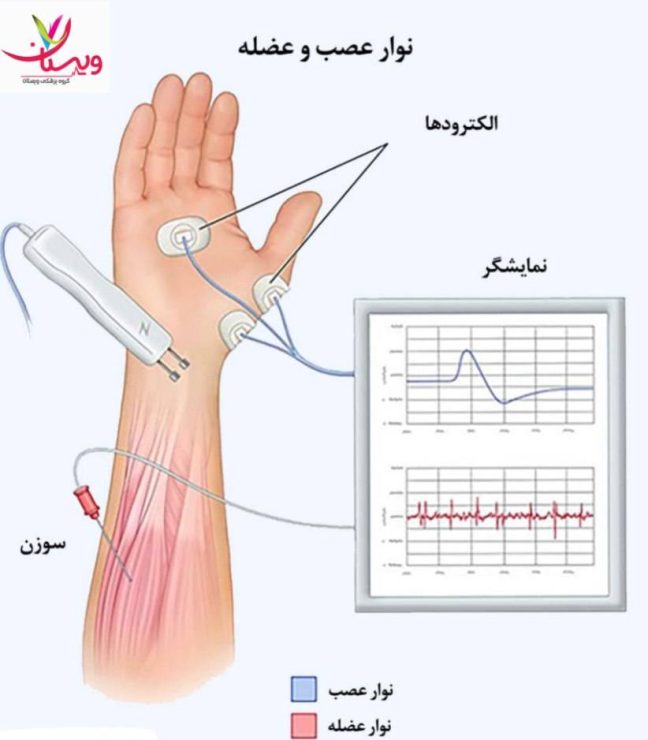 مراحل انجام تست نوار عصب و عضله (EMG/NCV) برای بیماران دیابتی